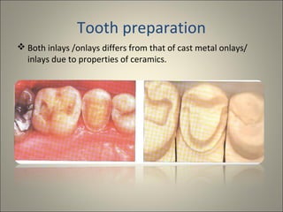 Tooth preparation
 Both inlays /onlays differs from that of cast metal onlays/
inlays due to properties of ceramics.

 