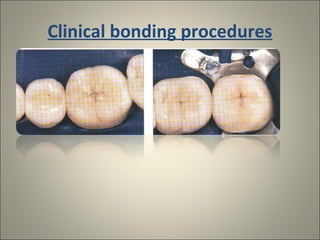 Clinical bonding procedures

 
