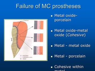 Failure of MC prostheses
 Metal oxide-
porcelain
 Metal oxide-metal
oxide (Cohesive)
 Metal - metal oxide
 Metal - porcelain
 Cohesive within
 