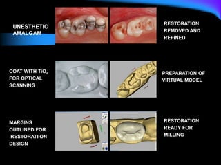 Unaesthetic amalgam restorations Restorations removed & preparations
Refined
Coat the preparations with Tio2 powder for Preparation of the virtual model
Optical scanning
Margins outlined for restoration design Occlusal view of the completed
restoration and ready for milling
UNESTHETIC
AMALGAM
RESTORATION
REMOVED AND
REFINED
COAT WITH TiO2
FOR OPTICAL
SCANNING
PREPARATION OF
VIRTUAL MODEL
MARGINS
OUTLINED FOR
RESTORATIION
DESIGN
RESTORATION
READY FOR
MILLING
 