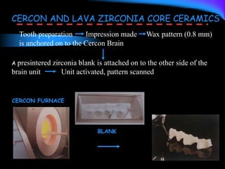 Tooth preparation Impression made Wax pattern (0.8 mm)
is anchored on to the Cercon Brain
A presintered zirconia blank is attached on to the other side of the
brain unit Unit activated, pattern scanned
CERCON AND LAVA ZIRCONIA CORE CERAMICS
CERCON FURNACE
BLANK
 