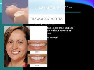 LUMINEERS
No prep technique.
Slightly stained, discolored, chipped,
maligned teeth without removal of
tooth structure.
Bonded to the enamel.
0.3 to 0.5 mm.
 