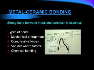 METAL-CERAMIC BONDING
Strong bond between metal and porcelain is essential
Types of bond
Mechanical entrapment
Compressive forces
Van der waal’s forces
Chemical bonding
 