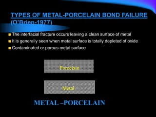 Porcelain
Metal
METAL –PORCELAIN
The interfacial fracture occurs leaving a clean surface of metal
It is generally seen when metal surface is totally depleted of oxide
Contaminated or porous metal surface
TYPES OF METAL-PORCELAIN BOND FAILURE
(O’Brien-1977)
 
