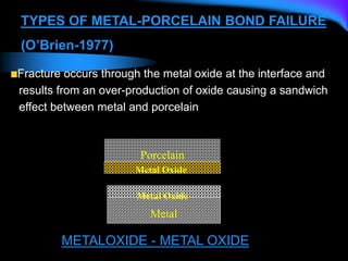 Porcelain
Metal Oxide
Metal Oxide
Metal
METALOXIDE - METAL OXIDE
TYPES OF METAL-PORCELAIN BOND FAILURE
(O’Brien-1977)
Fracture occurs through the metal oxide at the interface and
results from an over-production of oxide causing a sandwich
effect between metal and porcelain
 
