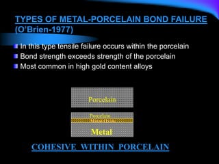 Porcelain
COHESIVE WITHIN PORCELAIN
Metal Oxide
Metal
Porcelain
TYPES OF METAL-PORCELAIN BOND FAILURE
(O’Brien-1977)
In this type tensile failure occurs within the porcelain
Bond strength exceeds strength of the porcelain
Most common in high gold content alloys
 
