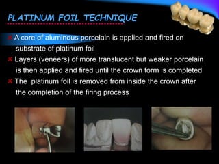 PLATINUM FOIL TECHNIQUE
A core of aluminous porcelain is applied and fired on
substrate of platinum foil
Layers (veneers) of more translucent but weaker porcelain
is then applied and fired until the crown form is completed
The platinum foil is removed from inside the crown after
the completion of the firing process
 