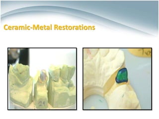 Ceramics for Dental Restorations , Ceramic-Metal Restorations ,All ...
