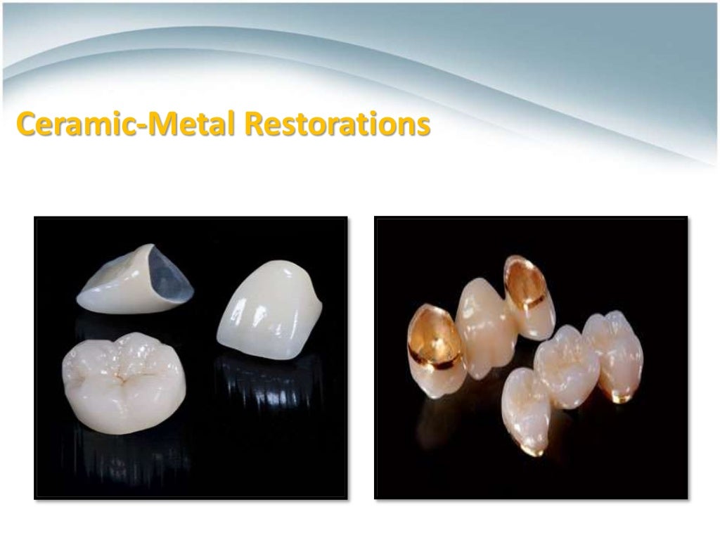Ceramics for Dental Restorations , CeramicMetal Restorations ,AllCe…