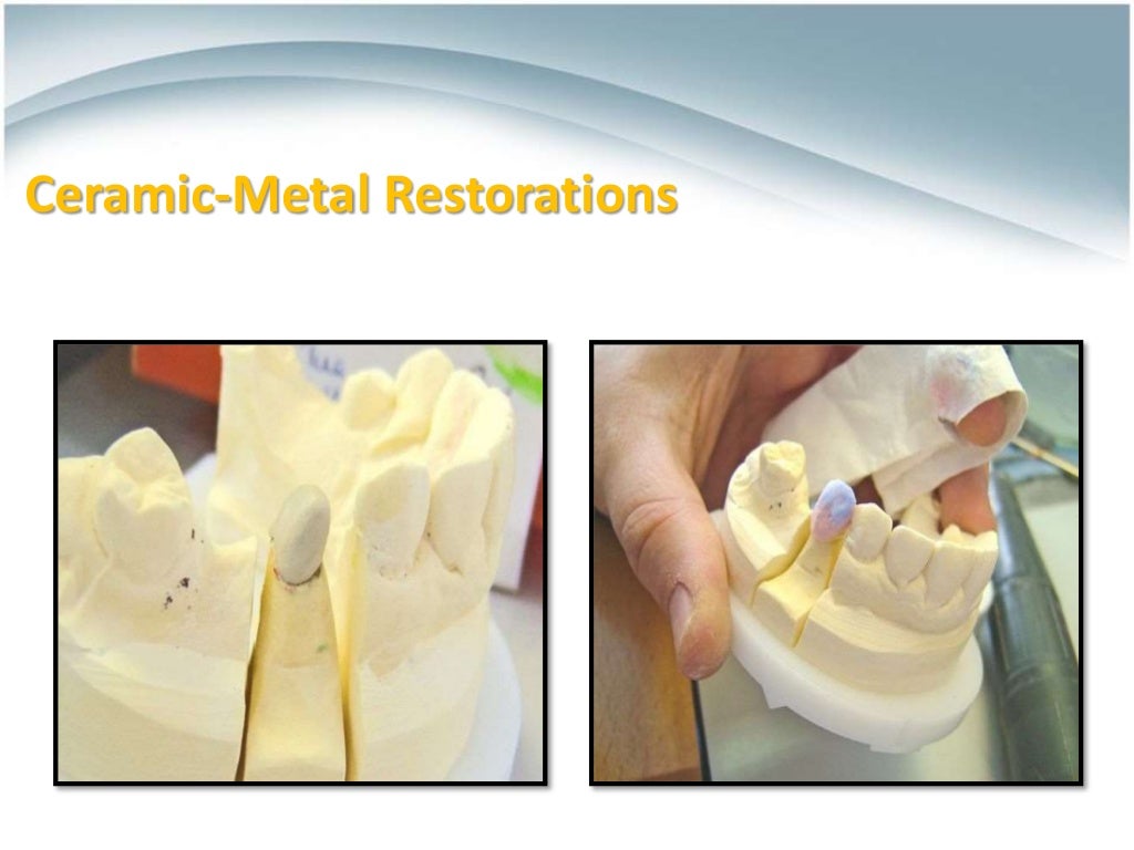 Ceramics for Dental Restorations , CeramicMetal Restorations ,AllCe…