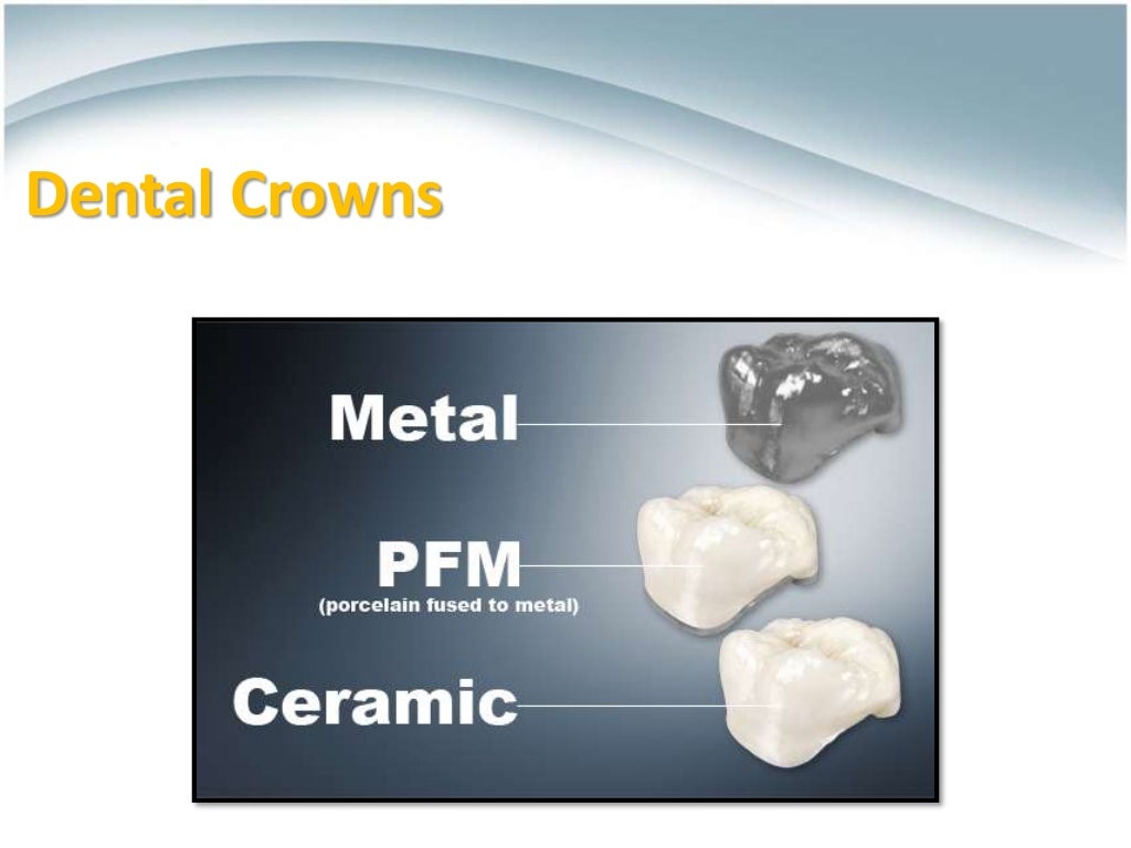 Ceramics for Dental Restorations , CeramicMetal Restorations ,AllCe…