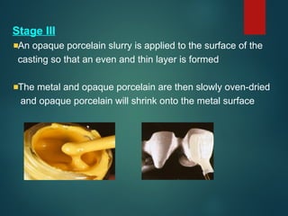 Stage III
An opaque porcelain slurry is applied to the surface of the
casting so that an even and thin layer is formed
The metal and opaque porcelain are then slowly oven-dried
and opaque porcelain will shrink onto the metal surface
 