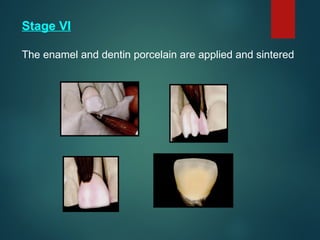 Stage VI
The enamel and dentin porcelain are applied and sintered
 