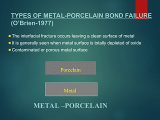 Porcelain
Metal
METAL –PORCELAIN
The interfacial fracture occurs leaving a clean surface of metal
It is generally seen when metal surface is totally depleted of oxide
Contaminated or porous metal surface
TYPES OF METAL-PORCELAIN BOND FAILURE
(O’Brien-1977)
 