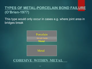 Metal
COHESIVE WITHIN METAL
Porcelain
Metal Oxide
Metal
TYPES OF METAL-PORCELAIN BOND FAILURE
(O’Brien-1977)
This type would only occur in cases e.g. where joint area in
bridges break
 