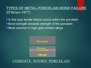 Porcelain
COHESIVE WITHIN PORCELAIN
Metal Oxide
Metal
Porcelain
TYPES OF METAL-PORCELAIN BOND FAILURE
(O’Brien-1977)
In this type tensile failure occurs within the porcelain
Bond strength exceeds strength of the porcelain
Most common in high gold content alloys
 