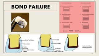BOND FAILURE
30
 
