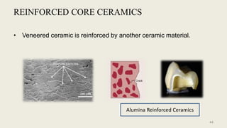 REINFORCED CORE CERAMICS
• Veneered ceramic is reinforced by another ceramic material.
Alumina Reinforced Ceramics
44
 