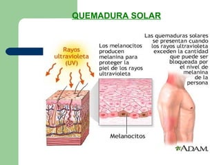 QUEMADURA SOLAR
 
