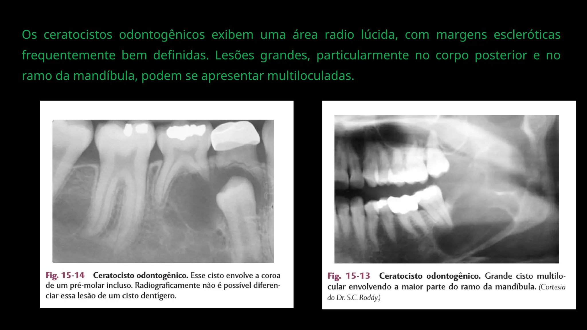 Os ceratocistos odontogênicos exibem uma área radio lúcida, com margens escleróticas
frequentemente bem definidas. Lesões grandes, particularmente no corpo posterior e no
ramo da mandíbula, podem se apresentar multiloculadas.
 