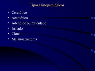 Tipos Histopatológicos
• Ceratótico
• Acantótico
• Adenóide ou reticulado
• Irritado
• Clonal
• Melanoacantoma
 