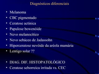 Diagnósticos diferenciais
• Melanoma
• CBC pigmentado
• Ceratose actínica
• Papulose bowenóide
• Nevo melanocítico
• Nevo sebáceo de Jadassohn
• Hiperceratose nevóide da aréola mamária
• Lentigo solar ??
• DIAG. DIF. HISTOPATOLÓGICO
• Ceratose seborreica irritada vs. CEC
 