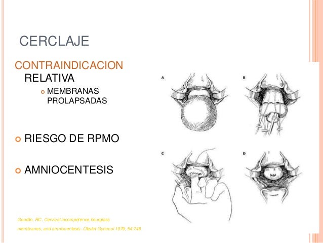 Mcdonald cervical cerclage video