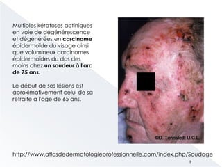 Multiples kératoses actiniques
en voie de dégénérescence
et dégénérées en carcinome
épidermoïde du visage ainsi
que volumineux carcinomes
épidermoïdes du dos des
mains chez un soudeur à l'arc
de 75 ans.
Le début de ses lésions est
aproximativement celui de sa
retraite à l'age de 65 ans.
http://www.atlasdedermatologieprofessionnelle.com/index.php/Soudage
9
 