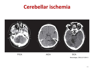 Cerebellar ischemia
43
 