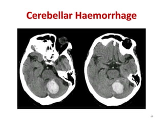 Cerebellar Haemorrhage
44
 