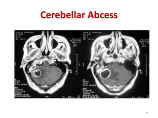 Cerebellar Abcess
45
 