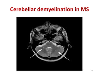 Cerebellar demyelination in MS
46
 