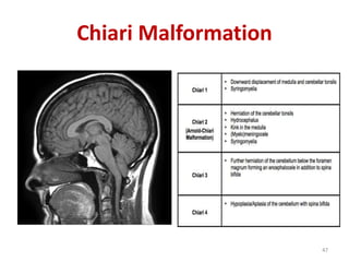 Chiari Malformation
47
 