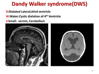 Dandy Walker syndrome(DWS)
D:Dialated Lateral,third ventricle
W:Water:Cystic dialation of 4th Ventricle
S:Small: vermis, Cerebellum
48
 