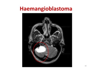 Haemangioblastoma
60
 