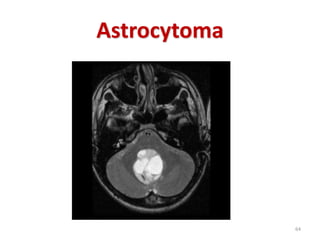 Astrocytoma
64
 