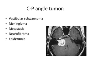 C-P angle tumor:
• Vestibular schwannoma
• Meningioma
• Metastasis
• Neurofibroma
• Epidermoid
 