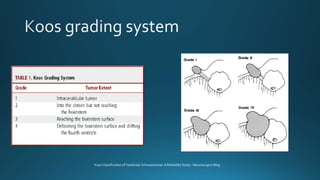 Koos Classification of Vestibular Schwannomas: A Reliability Study - Neurosurgery Blog
 