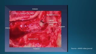 Source – AANS video journal
 