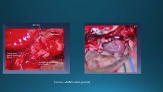 Source – AANS video journal
 