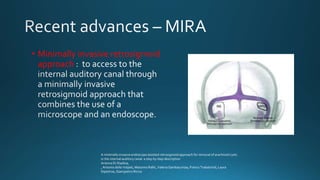 • Minimally invasive retrosigmoid
approach
A minimally invasive endoscope assisted retrosigmoid approach for removal of arachnoid cysts
in the internal auditory canal: a step by step description
Arianna Di Stadioa,
, Antonio della Volpeb, Massimo Rallic, Valeria Gambacortaa, Franco Trabalzinid, Laura
Dipietroe, Giampietro Riccia
 