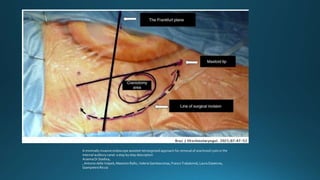 A minimally invasive endoscope assisted retrosigmoid approach for removal of arachnoid cysts in the
internal auditory canal: a step by step description
Arianna Di Stadioa,
, Antonio della Volpeb, Massimo Rallic, Valeria Gambacortaa, Franco Trabalzinid, Laura Dipietroe,
Giampietro Riccia
 
