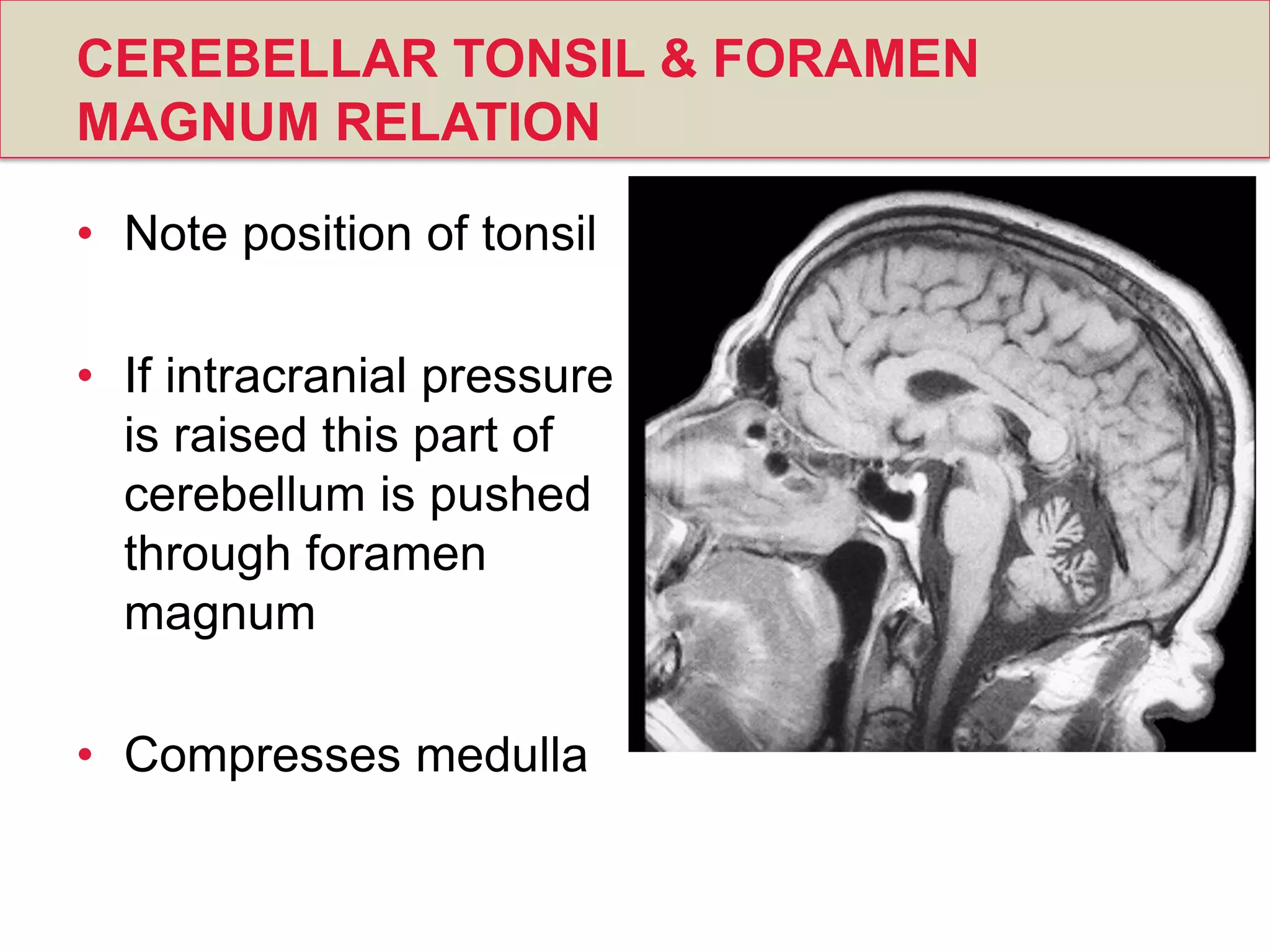 CEREBELLAR TONSIL & FORAMEN
MAGNUM RELATION
• Note position of tonsil
• If intracranial pressure
is raised this part of
cerebellum is pushed
through foramen
magnum
• Compresses medulla
 