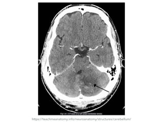 https://teachmeanatomy.info/neuroanatomy/structures/cerebellum/
Fig 1.4 – CT scan of a left sided cerebellar stroke.
 