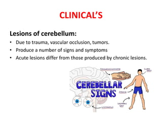 CLINICAL’S
Lesions of cerebellum:
• Due to trauma, vascular occlusion, tumors.
• Produce a number of signs and symptoms
• Acute lesions differ from those produced by chronic lesions.
 