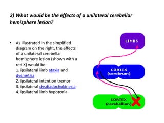 2) What would be the effects of a unilateral cerebellar
hemisphere lesion?
• As illustrated in the simplified
diagram on the right, the effects
of a unilateral cerebellar
hemisphere lesion (shown with a
red X) would be:
1. ipsilateral limb ataxia and
dysmetria
2. ipsilateral intention tremor
3. ipsilateral dysdiadochokinesia
4. ipsilateral limb hypotonia
 