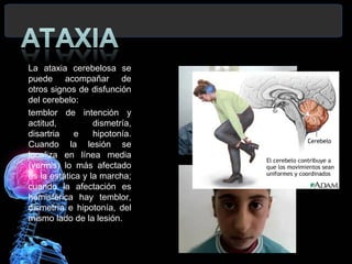 La ataxia cerebelosa se
puede acompañar de
otros signos de disfunción
del cerebelo:
temblor de intención y
actitud,          dismetría,
disartria    e    hipotonía.
Cuando la lesión se
localiza en línea media
(vermis) lo más afectado
es la estática y la marcha;
cuando la afectación es
hemisférica hay temblor,
dismetría e hipotonía, del
mismo lado de la lesión.
 