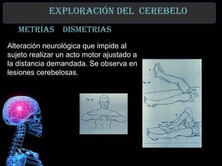 exploraCIón del Cerebelo
   metrías dIsmetrIas
Alteración neurológica que impide al
sujeto realizar un acto motor ajustado a
la distancia demandada. Se observa en
lesiones cerebelosas.
 