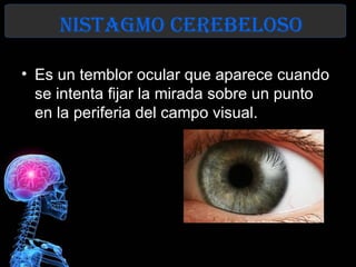 nIstaGmo Cerebeloso

• Es un temblor ocular que aparece cuando
  se intenta fijar la mirada sobre un punto
  en la periferia del campo visual.
 