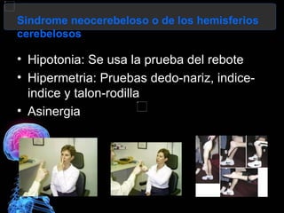 Sindrome neocerebeloso o de los hemisferios
cerebelosos

• Hipotonia: Se usa la prueba del rebote
• Hipermetria: Pruebas dedo-nariz, indice-
  indice y talon-rodilla
• Asinergia
 